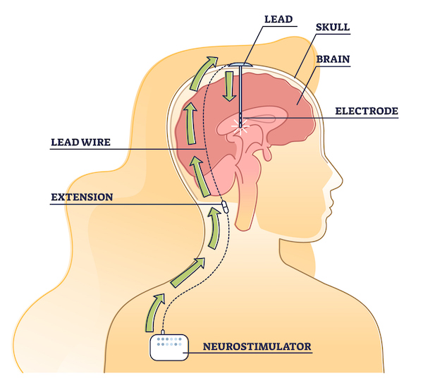 Diagram of brain stimulation, showing the placement of the lead, electrode, and neurostimulator