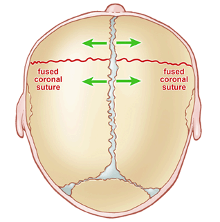 A diagram of an infant's skull with a fused coronal suture.