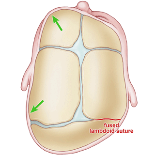 A diagram of an infant's skull with a fused lambdoid suture.