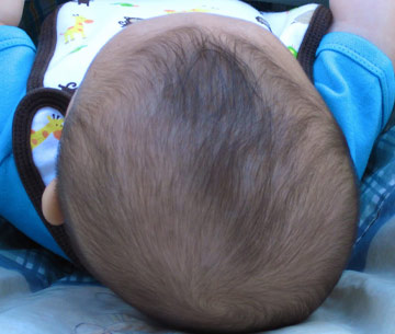 A photo of the top of an infant's head who experiences plagiocephaly.