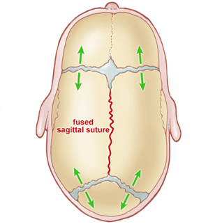 A diagram of an infant's skull with a fused sagittal suture.