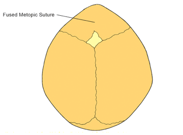 A diagram of an infant's skull with a fused metopic suture.