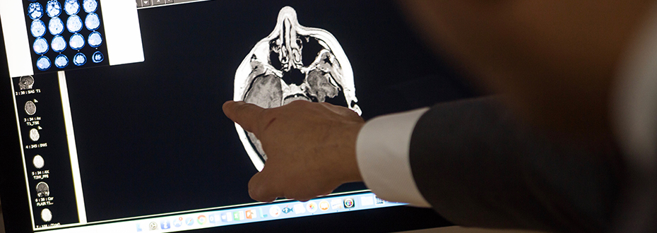 Facial Pain (Trigeminal Neuralgia) photo of a hand pointing to a head scan