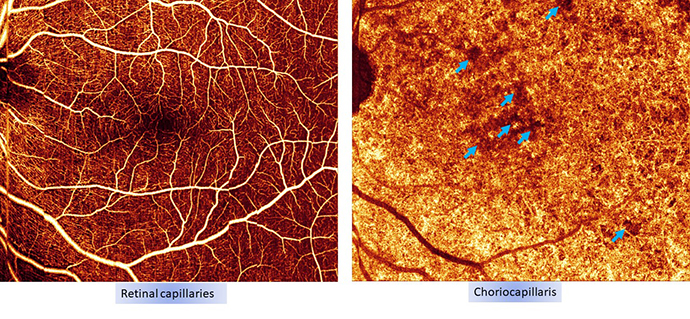 Optical coherence tomography angiography image of a patient's retina with dry macular degeneration.