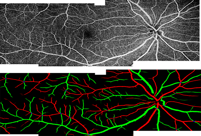 Artery and vein differentiation captured using OCT by the Casey Reading Center