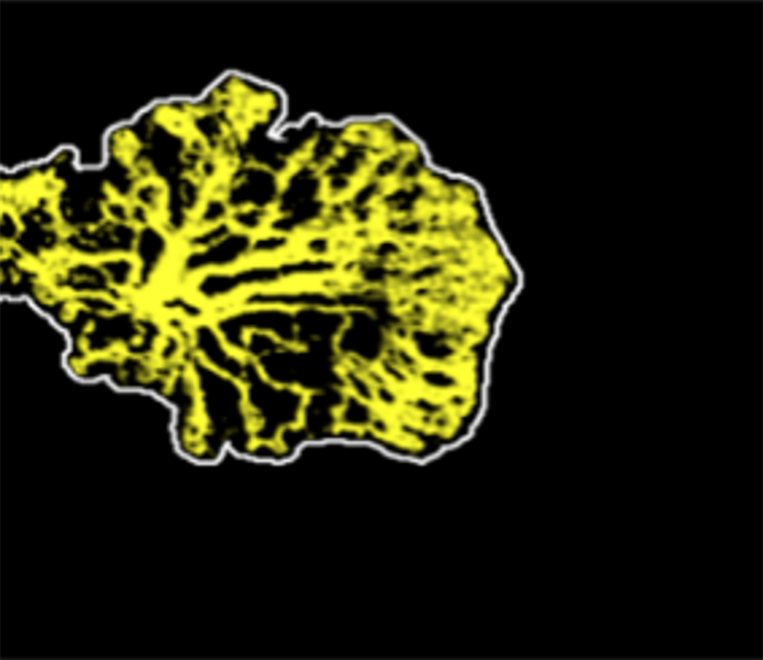 Image of choroidal neovascularization captured by the Casey Reading Center