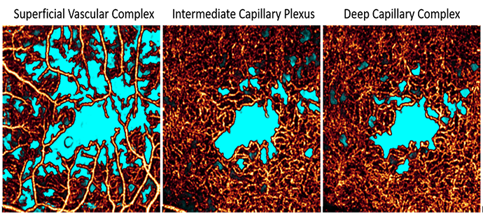 Image of Plexus-Specific Non-Perfusion Area captured by the Casey Reading Center