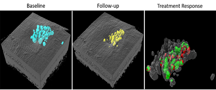 Image of retinal fluid quantification using OCTA from the Casey Reading Center