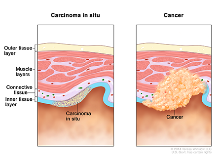 Two side-by-side diagrams, the left illustrating tissue with carcinoma in situ, and the right illustrating tissue with cancer.