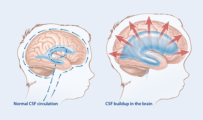 Illustration comparing normal central spinal fluid circulation with central spinal fluid buildup on the brain.