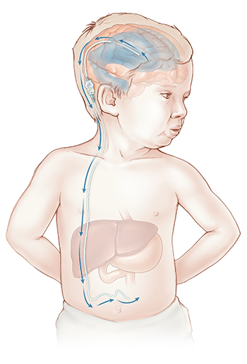 Illustration of a hydrocephalus shunt draining central spinal fluid from the brain to the abdomen.