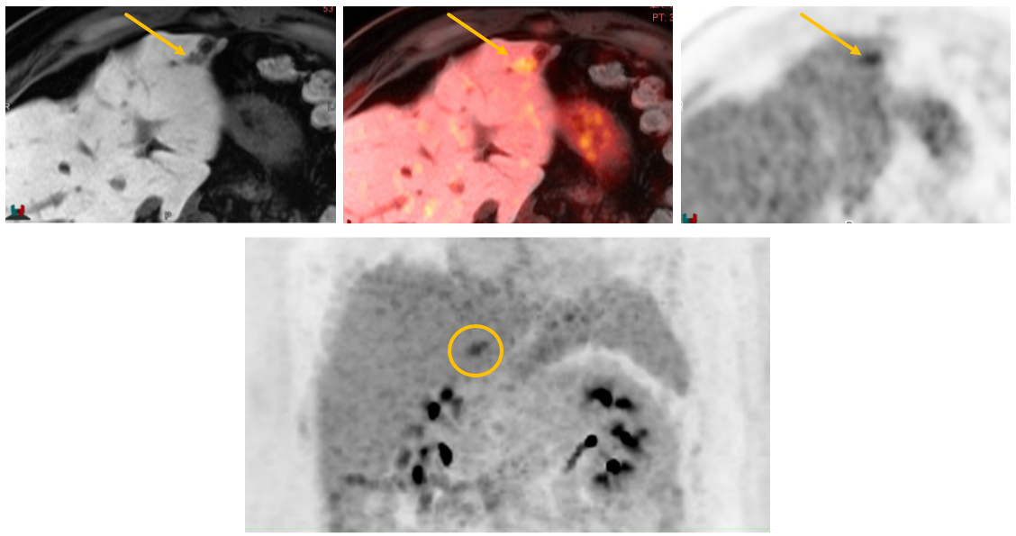 Three FDG PET MRI images of various views plus a liver MRI image with hepatobiliary specific contrast used to detect liver metastasis from colon cancer.