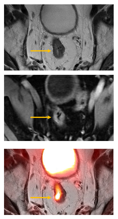 Three images with different views of FDG PET MRI plus rectal MRI used to detect local recurrence of rectal cancer.