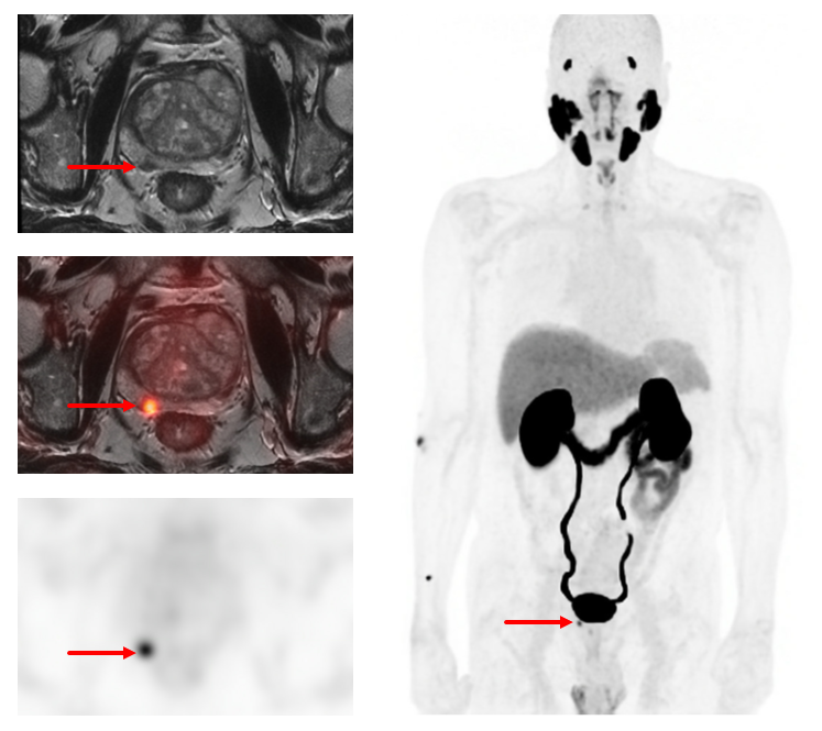 Four images depicting various imaging techniques and angles for PSMA PET MRI plus prostrate MRI used together to detect and stage prostate cancer.