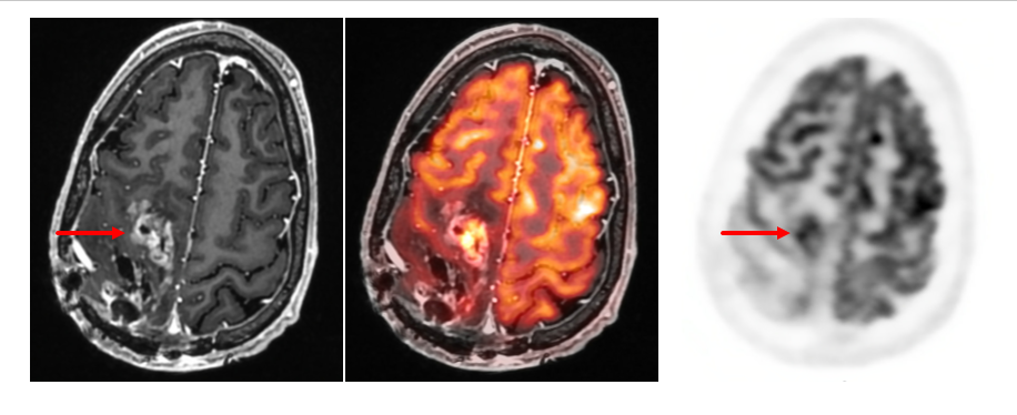 Diagnostic Radiology image of a FDG PET/MRI of the brain helping differentiate recurrent glioblastoma from radiation necrosis.