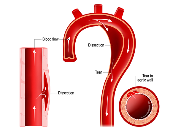 A diagram of the aorta showing a tear and dissection. There are also close-up views of the tear and dissection.