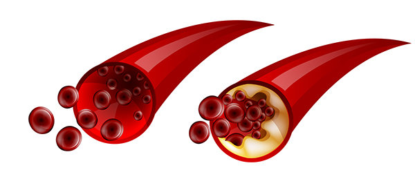 Side-by-side diagrams of a section of aorta, one with free-flowing blood cells, the other blocked, slowing the flow of blood cells.