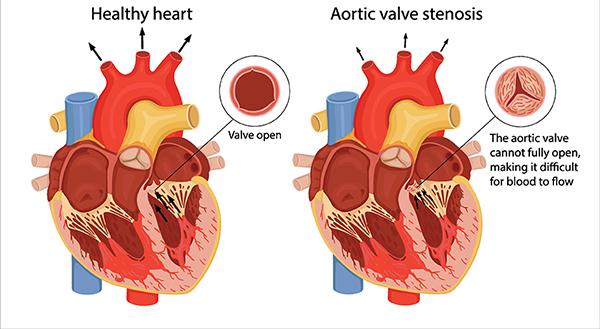 Side-by-side diagrams of a healthy heart with an open aortic valve, and a heart with a partially closed aortic valve.