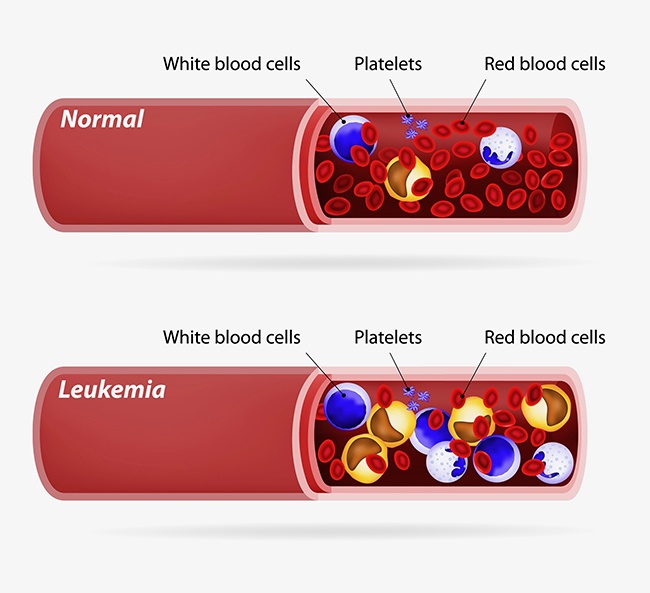 A diagram showing the bloodstream of a healthy child, and the bloodstream of a child with leukemia.