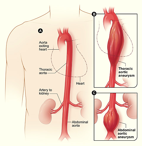 This model of a thoracic aortic aneurysm and an abdominal aortic aneurysm show how the aorta bulges.