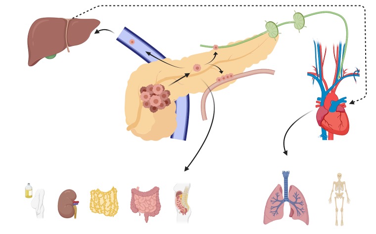 A diagram showing the avenues of metastasis from a primary pancreatic tumor including through the blood stream, lymphatic tissue, and perineural routes.  Pancreatic cancer can disseminate to many different organs, but typically metastasizes to the liver or lungs.