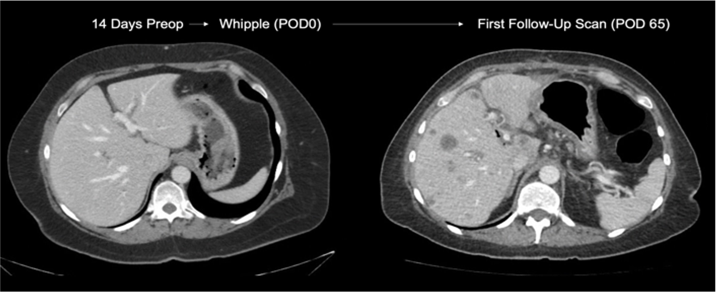 typical CT imaging findings in of rapid recurrence with a clear liver on the left and numerous dark circular liver metastases on the right, 65 days after surgery