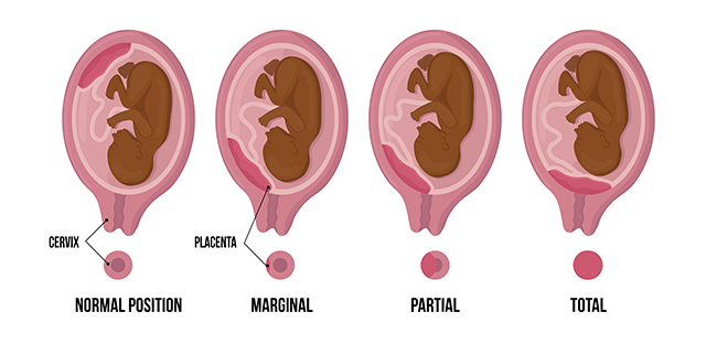 A diagram showing placenta previa at different levels of severity.