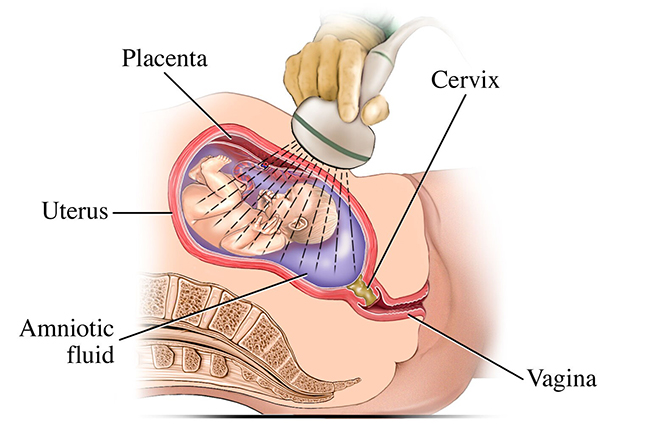 A diagram showing an ultrasound probe and a uterus, baby and placenta.