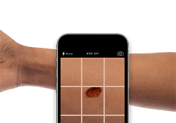 A mobile phone taking a photo of an arm for a dermatology e-visit.