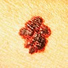Example of jagged melanoma borders