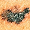 Example of colors of melanoma