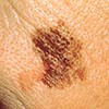 Example of size of melanoma mole