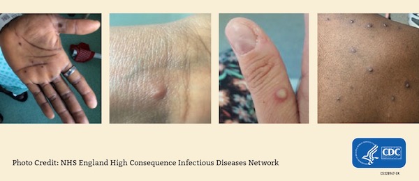 Visual examples of mpox rash.
