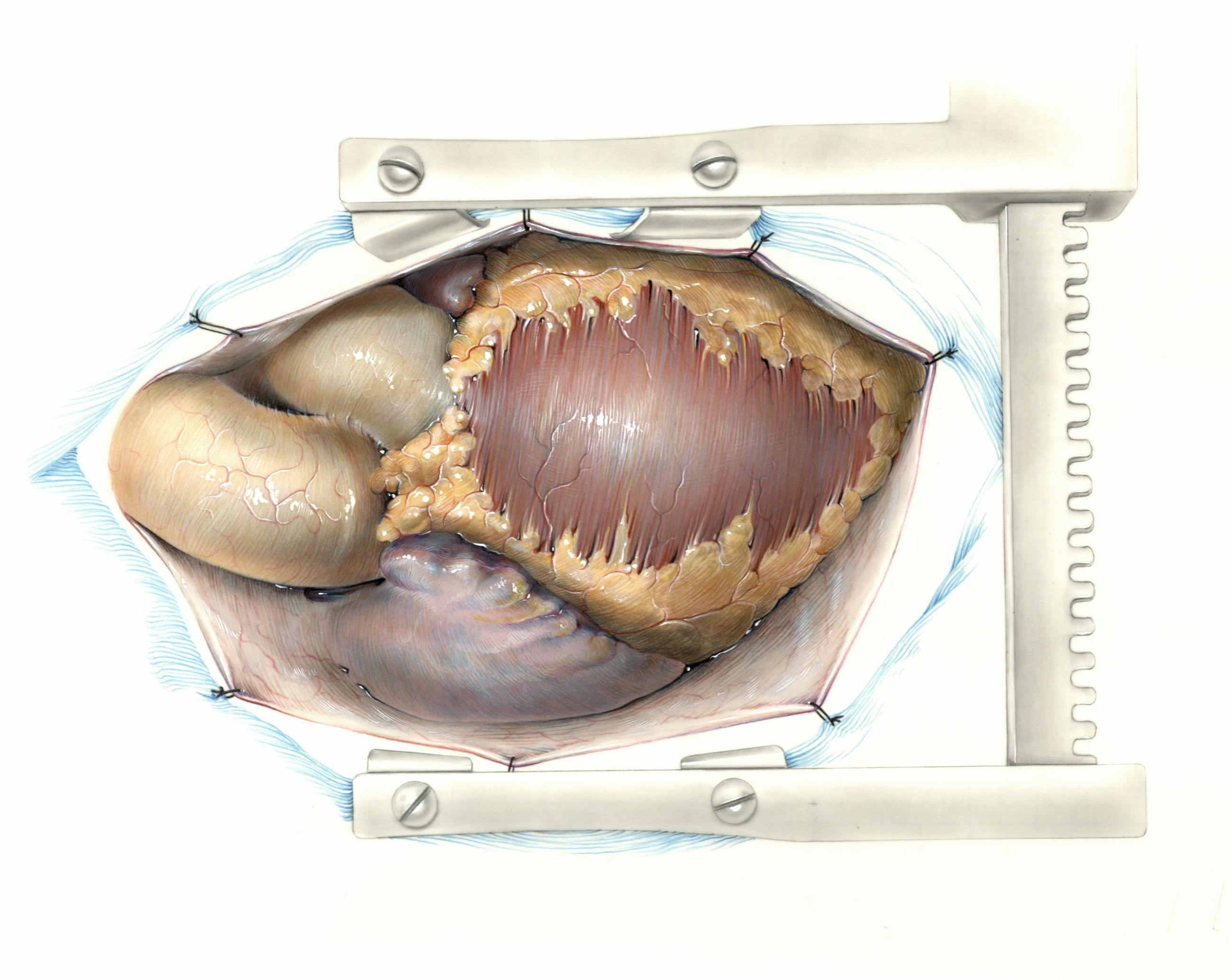 Color illustration: Proper exposure of the heart in an inverted-T fashion (front), undated