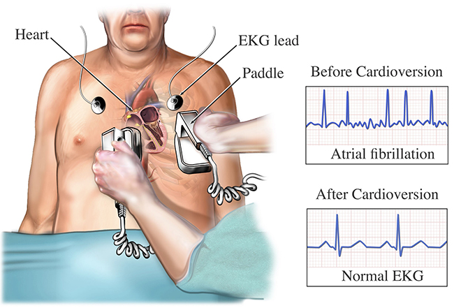 A medical illustration of an external cardioversion.