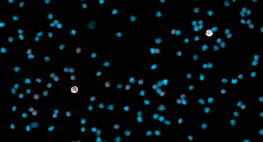 Image of microscopic circulating hybrid cells discovered at OHSU that may detect who has eye cancer that spreads outside the eye.