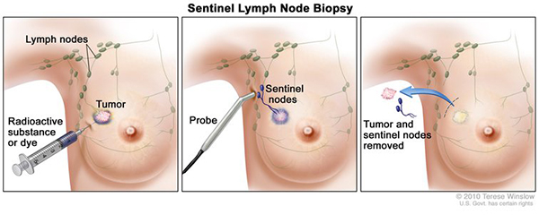 This drawing depicts lymph node biopsy in three panels. In the first panel, a radioactive dye is injected into a tumor in the breast. Next, a probe is inserted near the armpit to biopsy two lymph nodes. Finally, the tumor and two lymph nodes are removed.