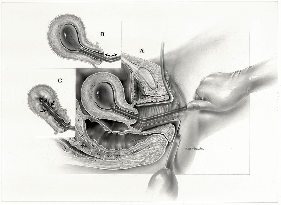 Carbon dust illustration depicting the uterine aspiration procedure