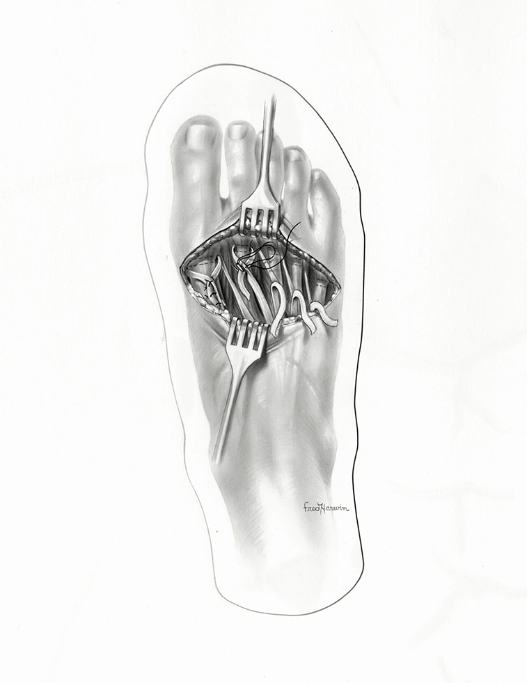 Black and white illustration: technique for transferring the long extensors to the metatarsal necks