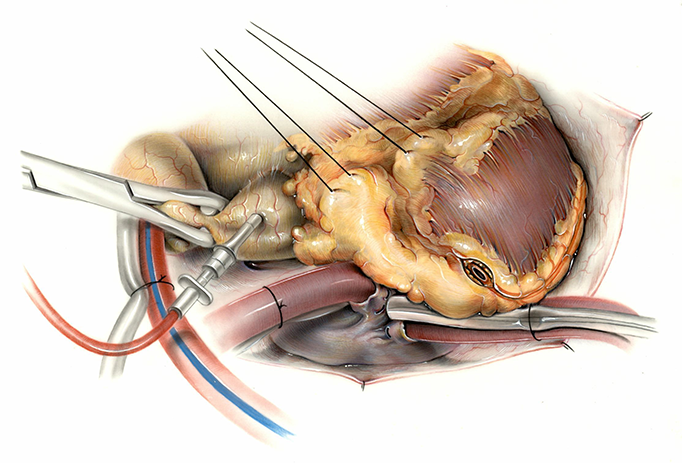 Color illustration: distal left anterior descending artery anastomosis, undated
