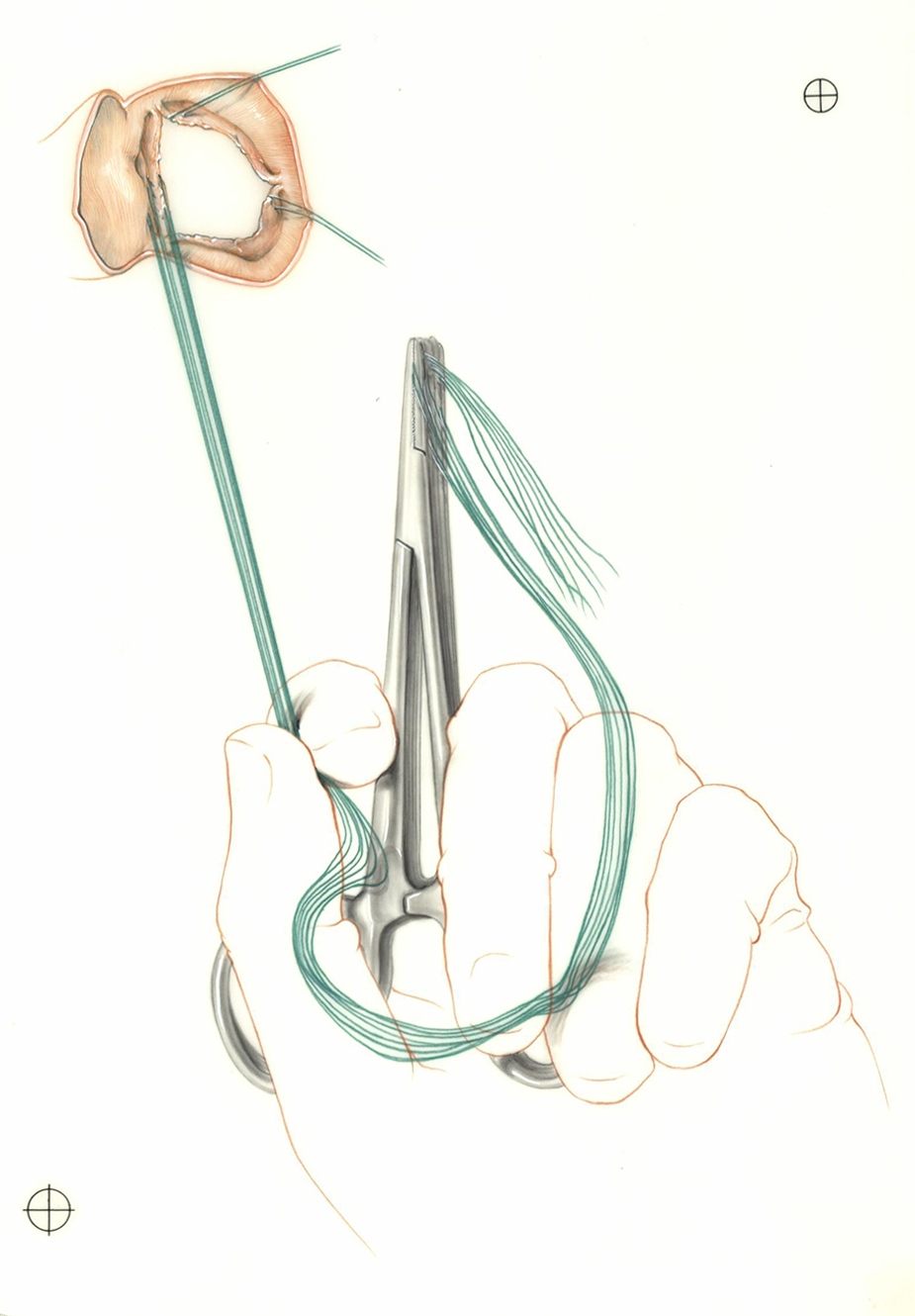 Color illustration of hand holding clamped sutures in heart valve surgery