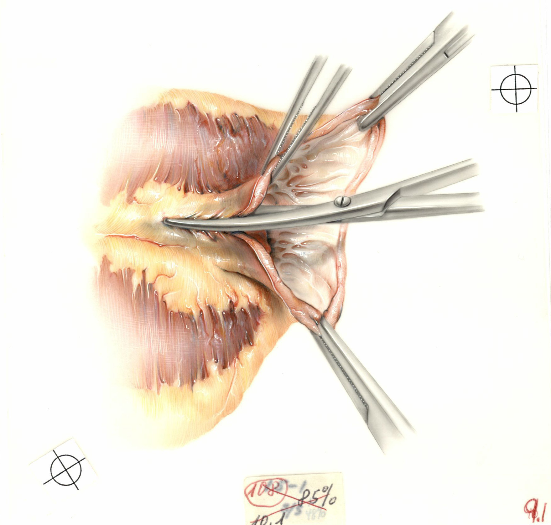 Color illustration of left ventricular aneurysm surgery, incision