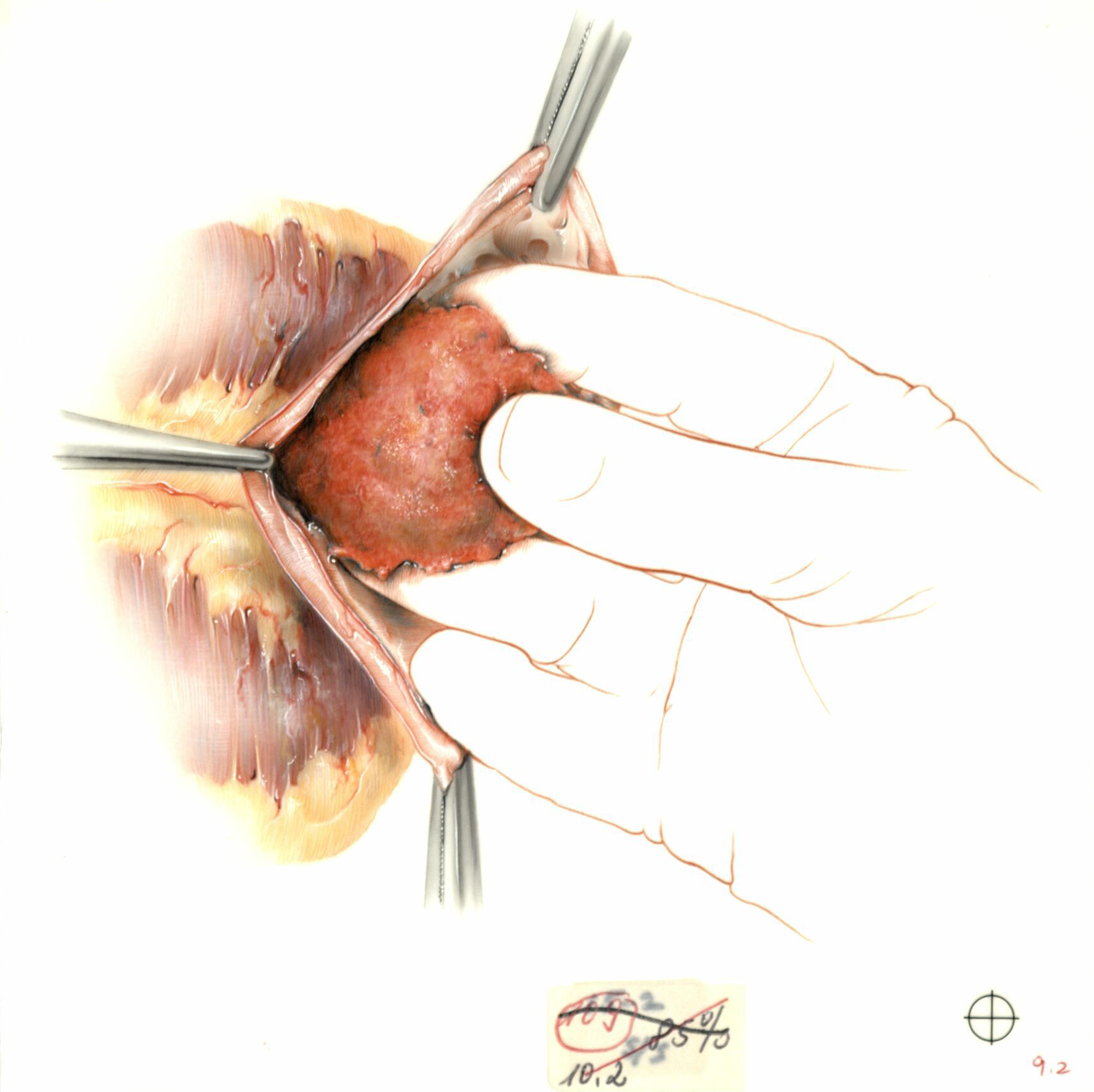 Color illustration of left ventricular aneurysm surgery, excision of clot.