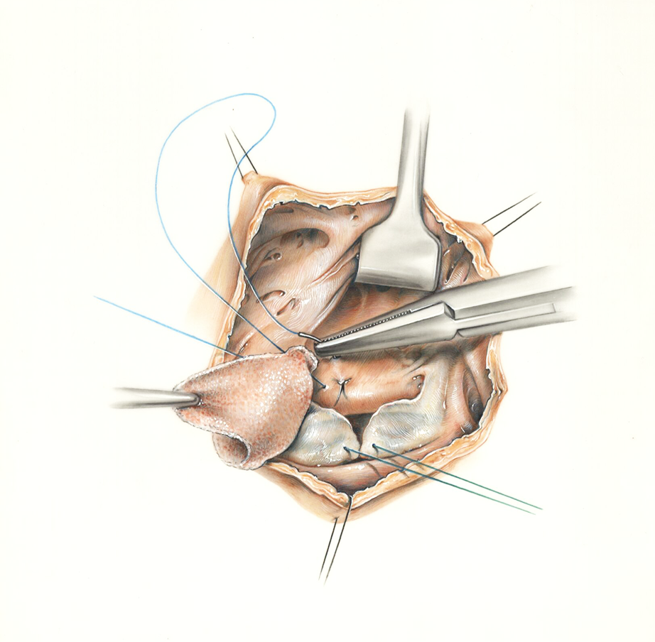 Color illustration of running suture of polypropylene in the inferior ventricular defect. 