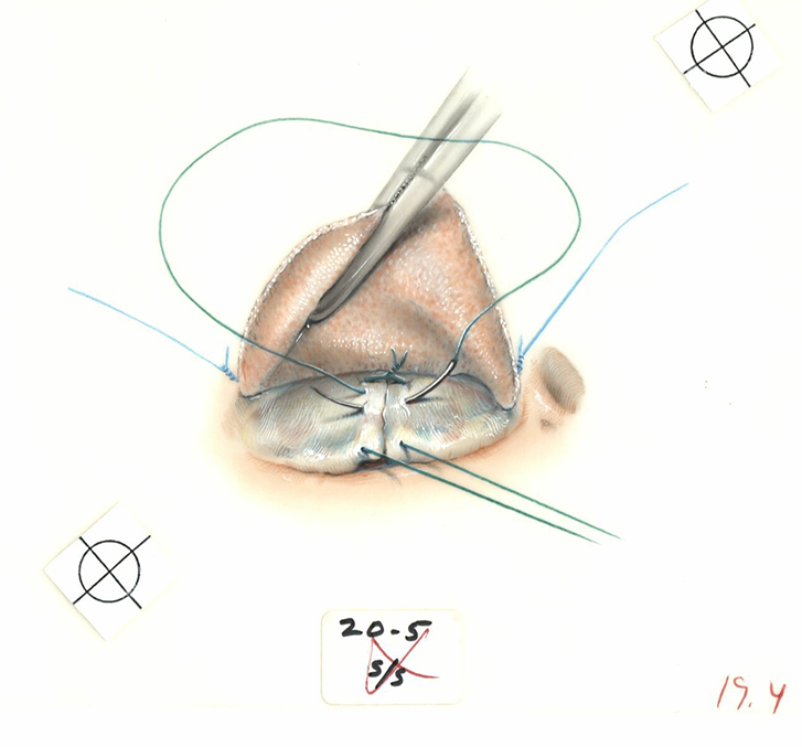 Color illustration of bicuspid repair of the anterior and posterior leaflets. 