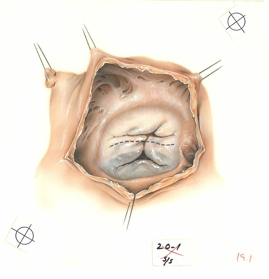Color illustration of location of incision of the anterior and posterior common leaflets