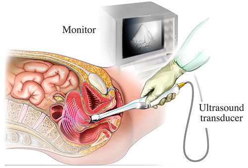 This illustration shows the inside of a pelvis during a transvaginal ultrasound.