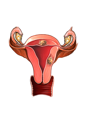 This diagram shows a uterus with two fibroids in its walls.