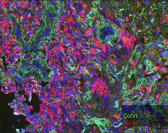 Colorful microscope image shows tumor cells stained with antibodies. The stained highlight cellular structures in pink, blue, and green.