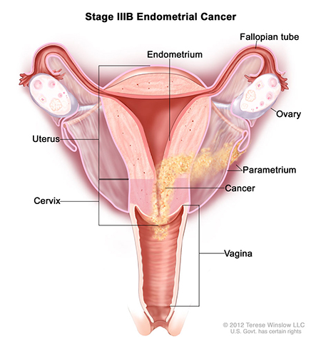 This medical illustration depicts Stage IIIB endometrial cancer. The diagram is centered on the uterus. The inner layer of the uterus is the endometrium. Surrounding that is a thick layer of muscle known as the myometrium. Surrounding the myometrium is a layer of connective tissue known as the parametrium. Cancer cells, shown in yellow, have colonized a section of the endometrium and spread through the myometrium to the parametrium. Cancer has also spread down towards the cervix.